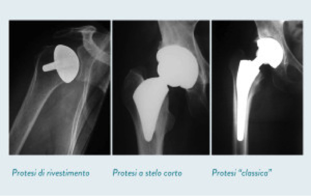 Immagine che raffigura le varie tipologie di protesi d'anca: Protesi di rivestimento, Protesi a stelo corto e Protesi classica.