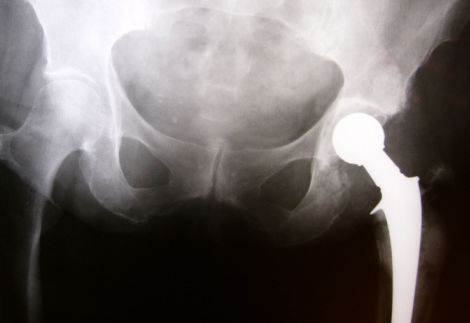 Immagine di una radiografia che mostra la protesi inserita nell'anca.