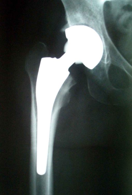 Immagine di una radiografia che mostra la protesi inserita nell'anca.